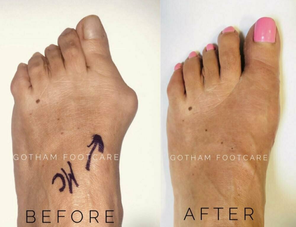 Are You Considering Bunion Surgery? | Blog | Gotham Footcare