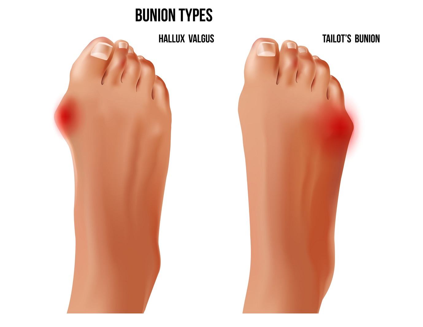 Understanding Tailors Bunion: Causes, Symptoms, and Treatment Options