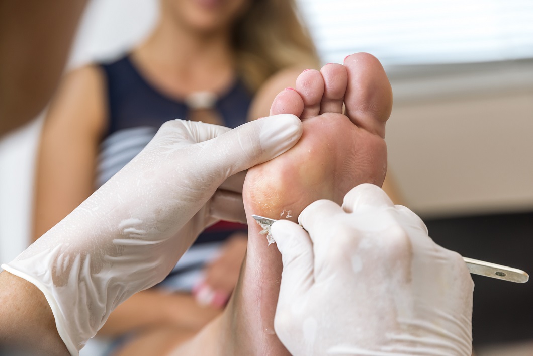 Can I Remove Minor Calluses from My Feet?