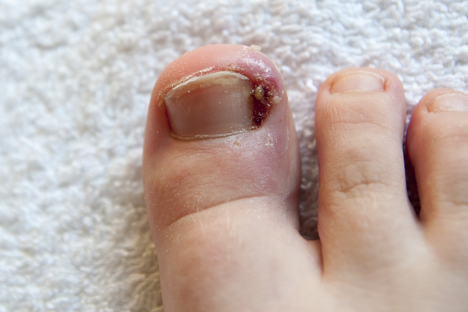 Do I Need to Visit a Foot Doctor for My Ingrown Toenail?  New York City Podiatrist