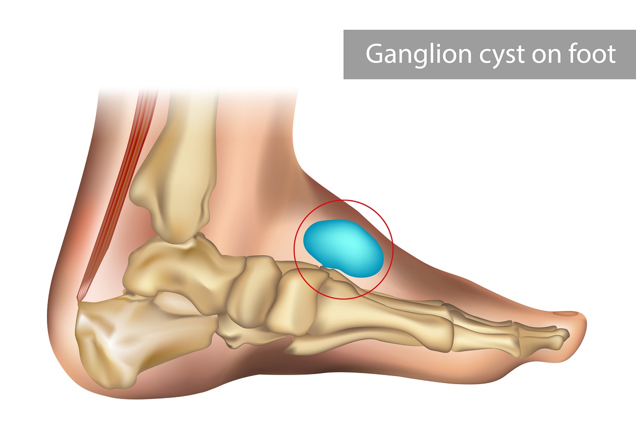 What Are Ganglion Cysts and How They Are Treated  New York City Podiatrist