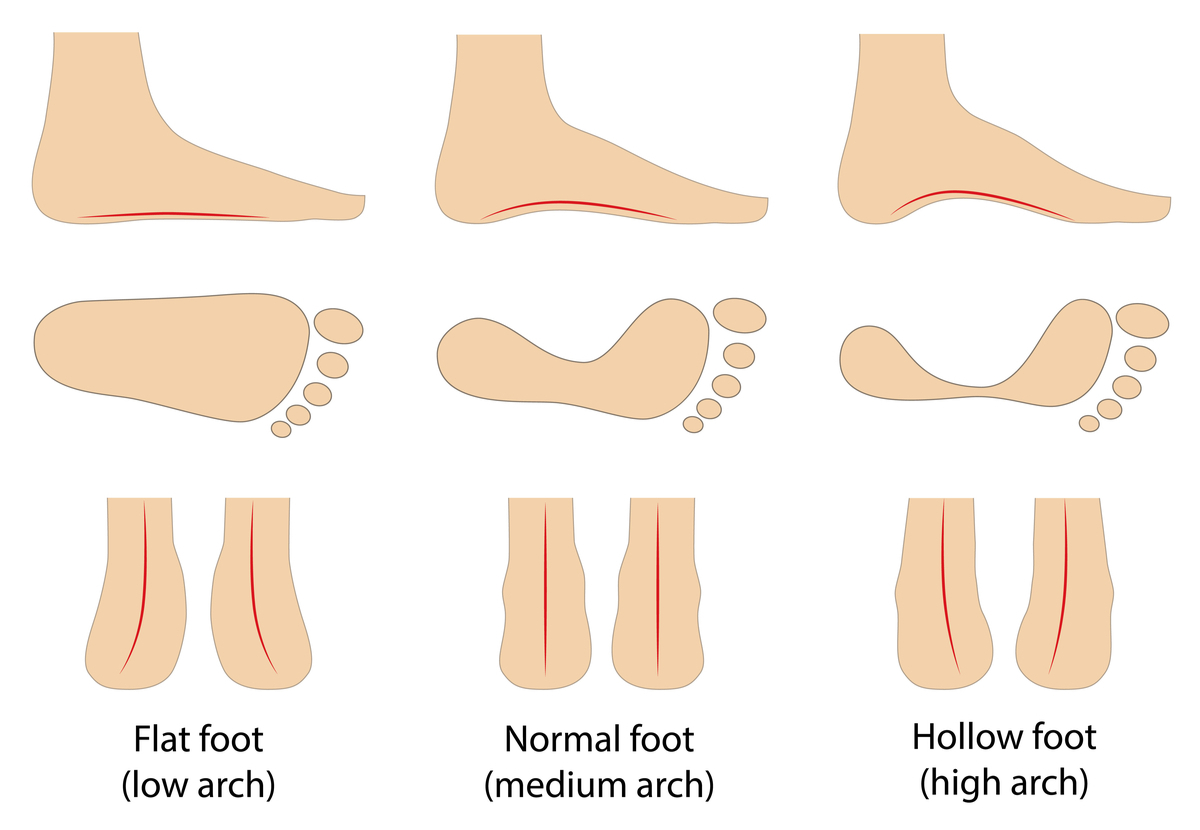 flat foot meaning
