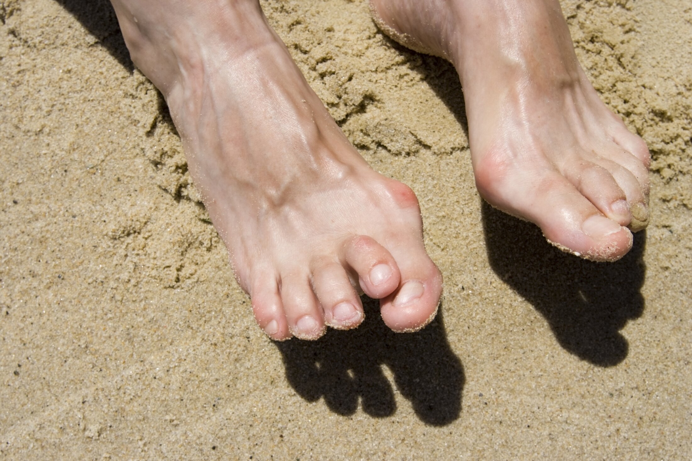 Medical Solutions for Crooked Toes | Blog | Gotham Footcare