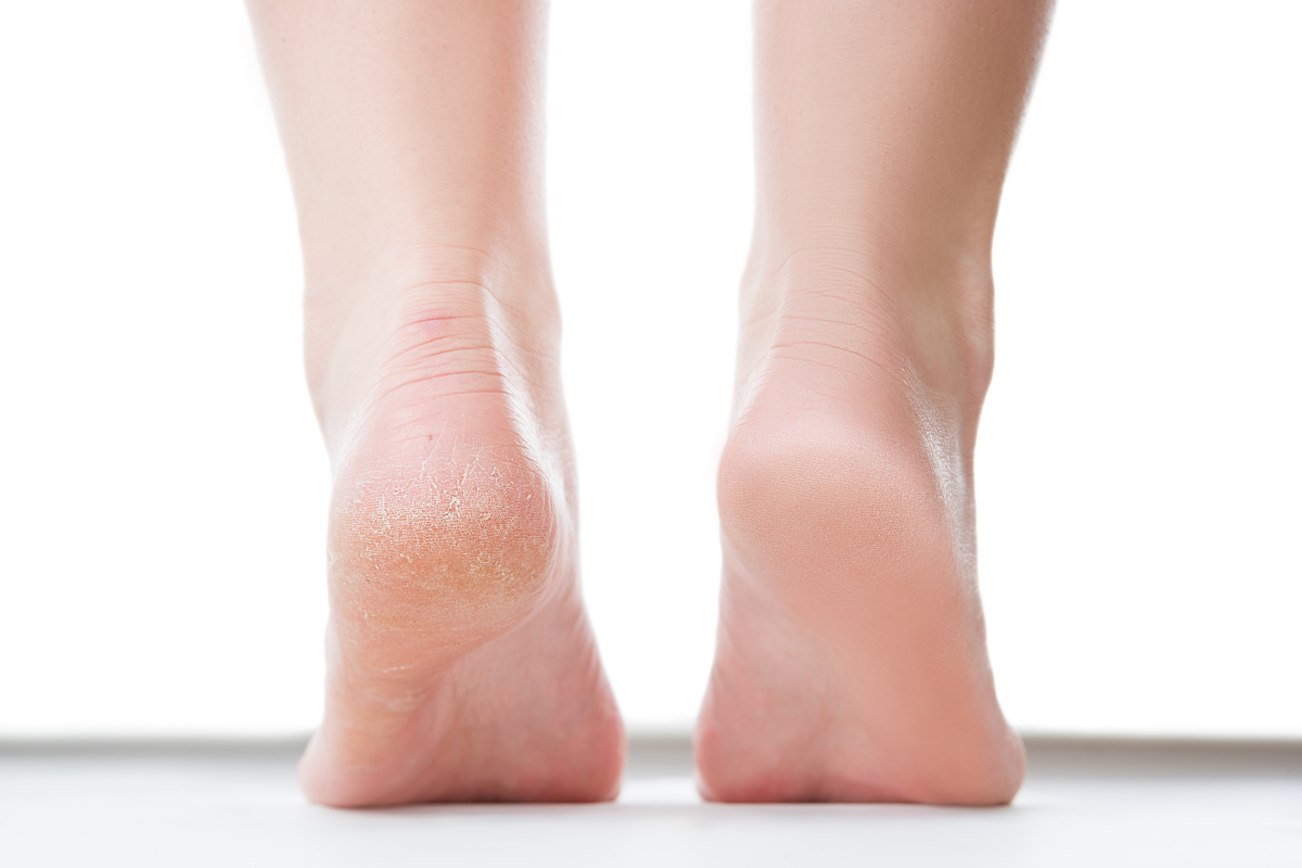Cracked Heels Causes | Family Foot & Ankle Centers