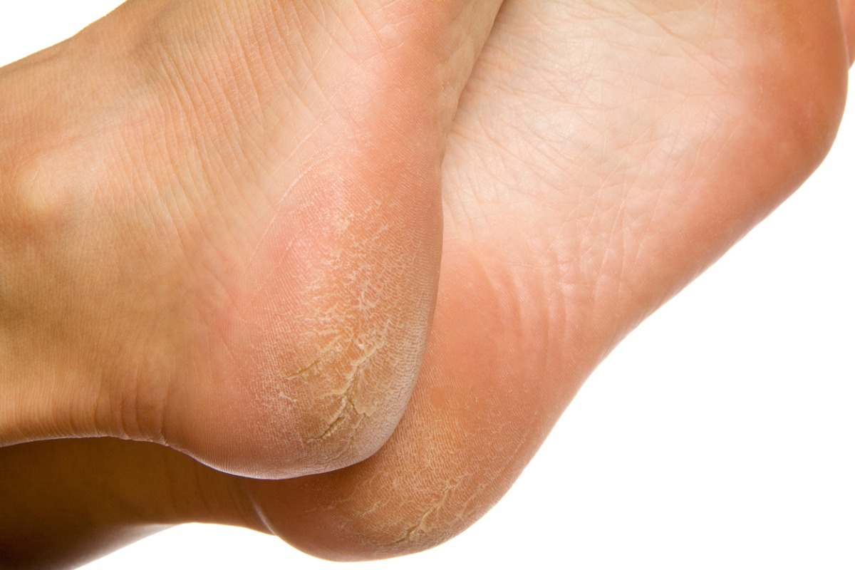What's your favorite way to treat cracked heels? #drypedicure #nailte... |  TikTok