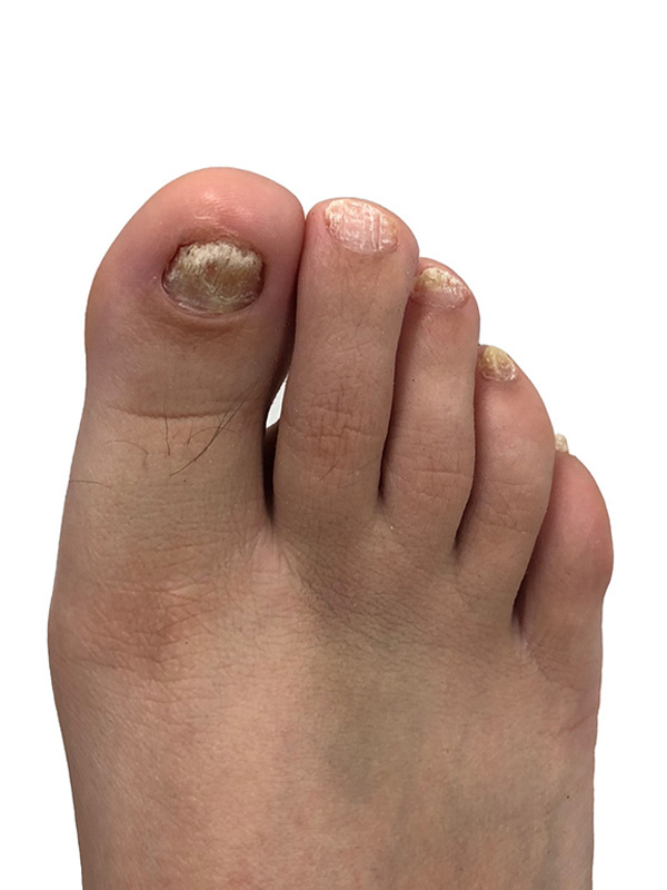 Nail Fungus Before & After Image